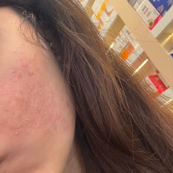 The Purest Solutions C Serumu Cilt Sorunlarına Yol Açtı!