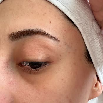 Konserve Yaprak Sarma Tüketimi Sonrası Gıda Zehirlenmesi Ve Mağduriyet