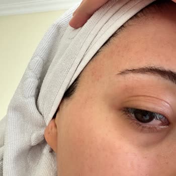 Konserve Yaprak Sarma Tüketimi Sonrası Gıda Zehirlenmesi Ve Mağduriyet