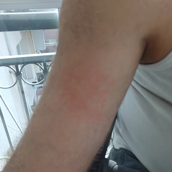 Contigo Termos Patlaması: Yanık Ve Güvenlik Riski Yaşadık