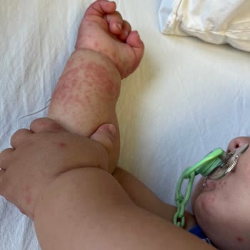 Çocuğumun Hastanede Kaldığı Sürede İlgisizlik Ve Yanlış Teşhis Mağduriyeti