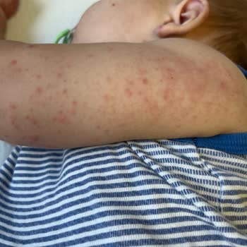 Çocuğumun Hastanede Kaldığı Sürede İlgisizlik Ve Yanlış Teşhis Mağduriyeti