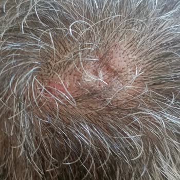 Elidor Şampuan Sonrası Saç Diplerimde İltihap Ve Kalıcı Zarar Yaşadım