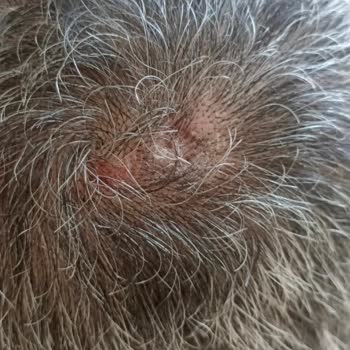 Elidor Şampuan Sonrası Saç Diplerimde İltihap Ve Kalıcı Zarar Yaşadım