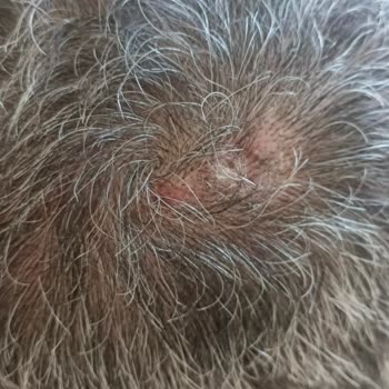 Elidor Şampuan Sonrası Saç Diplerimde İltihap Ve Kalıcı Zarar Yaşadım