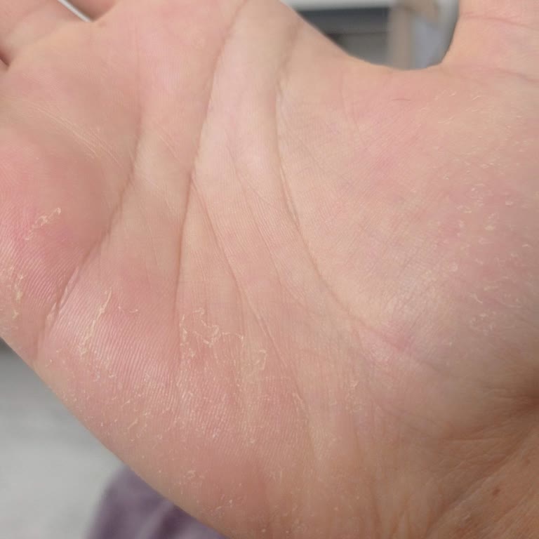 Cif Yeşil Sprey Kullanımı Sonrası Ellerimde Ciddi Soyulmalar Oluştu