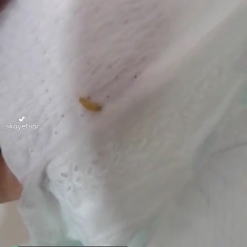 Prima Bebek Bezinde Canlı Larva