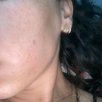 Yves Rocher Ürünleri Cildimde Yoğun Sivilce Ve Komedon Yaptı İade İstiyorum