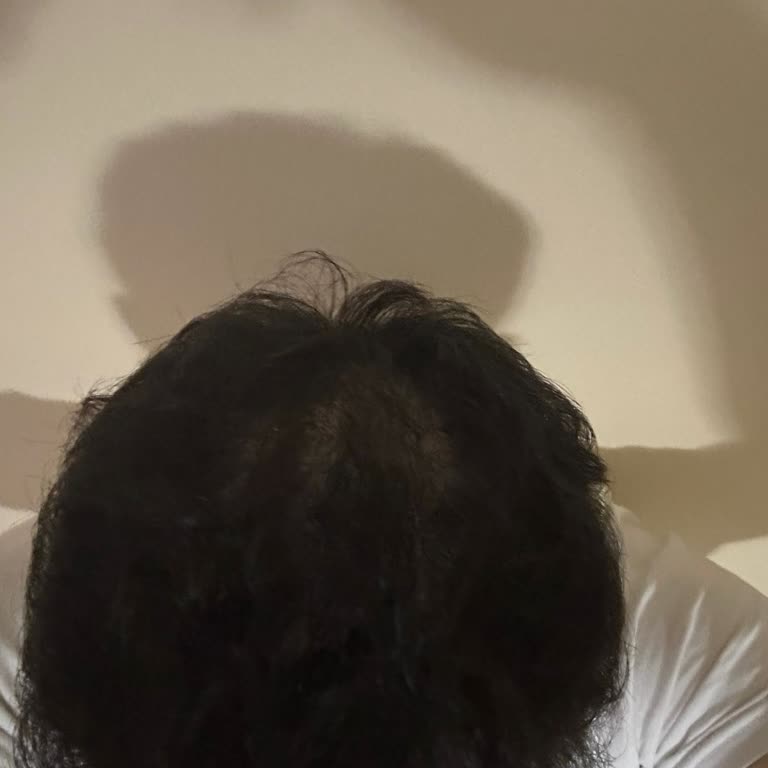 Celal Akfil Saç Gölgelendirme Merkezi Saç Simülasyonu Sonuçsuz Kaldı, Param Ve Zamanım Boşa Gitti