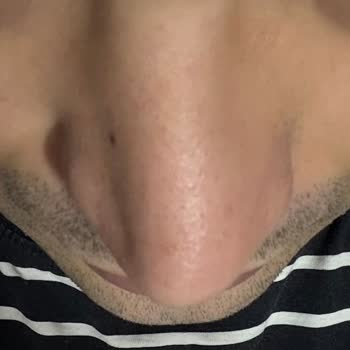 Burun Estetiği Sonrası Şekil Bozukluğu Ve Klinik İlgisizliği