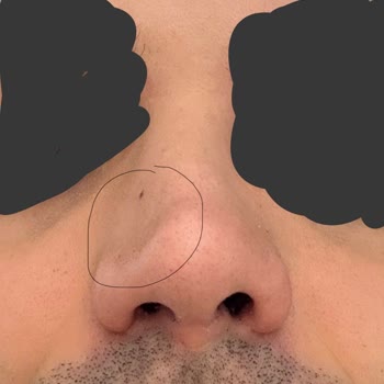 Burun Estetiği Sonrası Şekil Bozukluğu Ve Klinik İlgisizliği