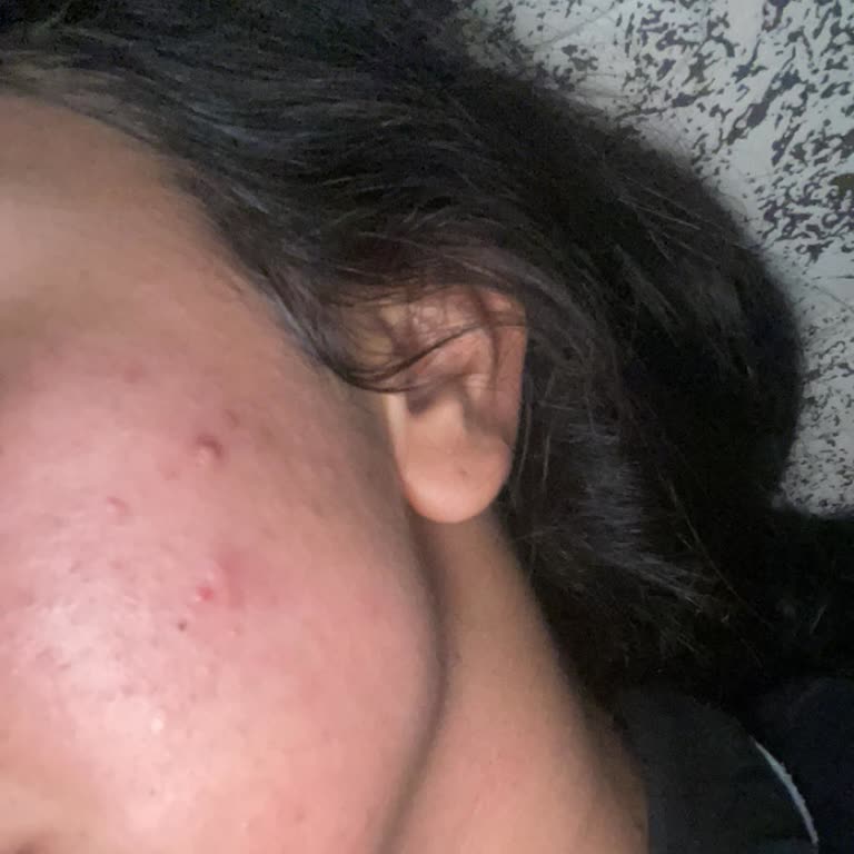 Cilt Ürünleri Yüzümde Ağır Sivilce Ve Mağduriyet Yarattı