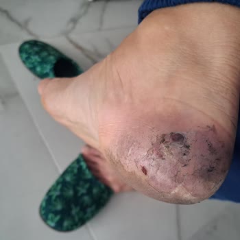 Işıkmen Ayakkabı (Balıkesir) İlk Giyişimde Ayaklarımı Boyadı