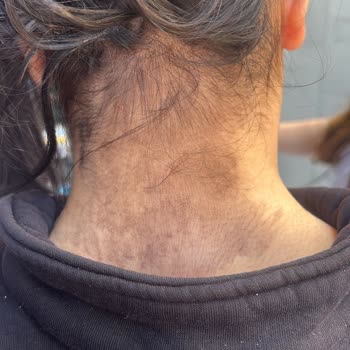 Yanlış Ve Zararlı Saç İşlemi Sonrası Mağduriyetim Giderilmiyor