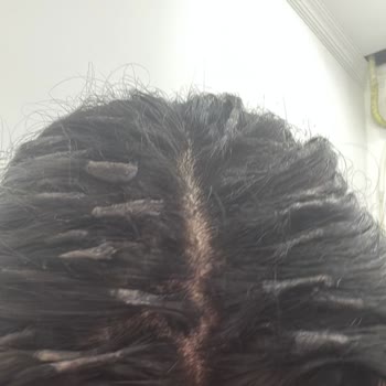 Yanlış Ve Zararlı Saç İşlemi Sonrası Mağduriyetim Giderilmiyor