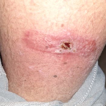 Tunçpek Smilebant Şikayeti