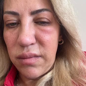 Yanlış Uygulama Sonrası Sağlık Sorunları Ve Ücret İadesi Talebi