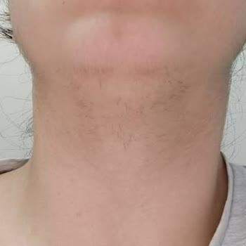 Asia Güzellik Merkezleri | İstanbul 10 Seans Almama Rağmen, Tüylerde Hiçbir Azalma Olmadı