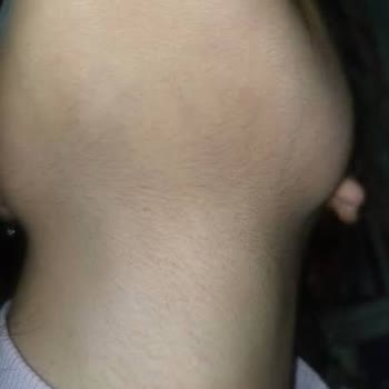 Asia Güzellik Merkezleri | İstanbul 10 Seans Almama Rağmen, Tüylerde Hiçbir Azalma Olmadı