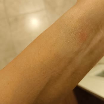 Akıllı Saat Cildimde Alerji Ve Yanık Görünümlü Hasara Sebep Oldu