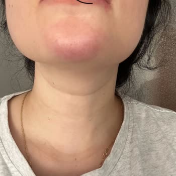 Su Estetik Cerrahi İşlem Sonrası Dudağımda Ciddi Bir Yamukluk Oluştu