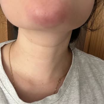 Su Estetik Cerrahi İşlem Sonrası Dudağımda Ciddi Bir Yamukluk Oluştu