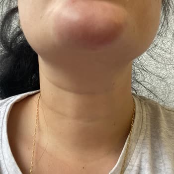 Su Estetik Cerrahi İşlem Sonrası Dudağımda Ciddi Bir Yamukluk Oluştu