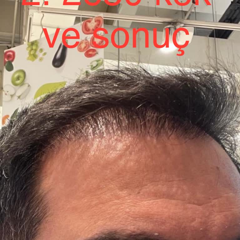 Başarısız Saç Ekimi Operasyonları Sonrası Mağduriyet Ve Yetersiz Çözüm