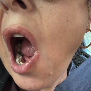 Bir Diş İçin Bitmeyen Ağrı Ve Hatalı Tedavi Süreci