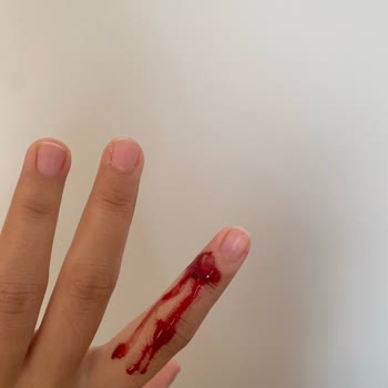 Ambalajdaki Plastik Çıkıntı Parmağımı Kesti, Güvenim Sarsıldı