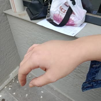 Acil Serviste İlgisizlik Ve Yanlış Müdahale Sonucu Elimde Kalıcı Hasar Oluştu