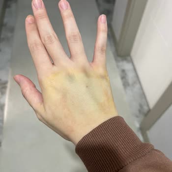 Acil Serviste İlgisizlik Ve Yanlış Müdahale Sonucu Elimde Kalıcı Hasar Oluştu