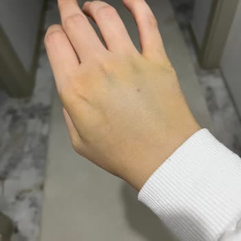 Acil Serviste İlgisizlik Ve Yanlış Müdahale Sonucu Elimde Kalıcı Hasar Oluştu