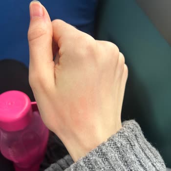 Starbucks Termosunun Patlaması Sonucu Yaşanan Yanık Ve Güvenlik Sorunu