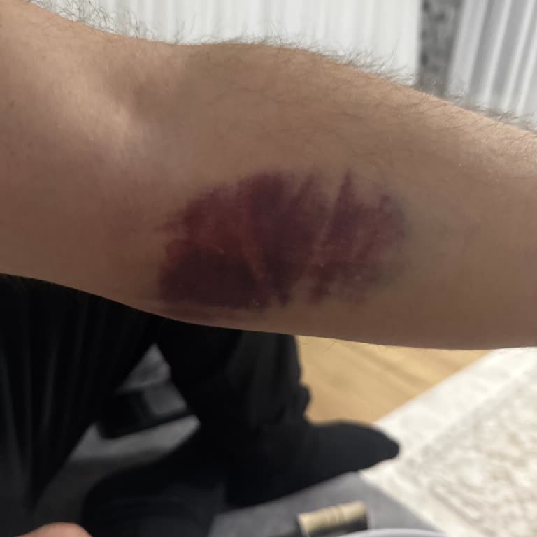 Kardiyoloji Bölümünde Kan Alma İşlemi Sonrası Şişlik Ve Morarma