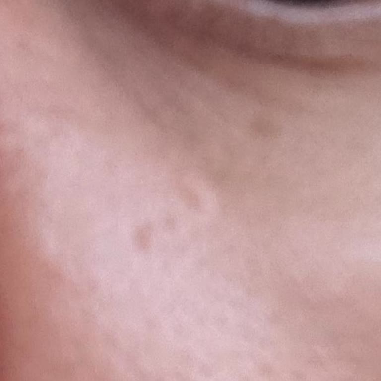 Yves Rocher Cilt Bakım Ürünleri Yüzümde Ağrılı Sivilce Ve Soyulmaya Sebep Oldu, Tedavi Masrafı Çıktı