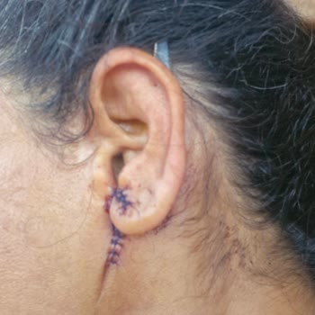 Ameliyat Sonrası Mağduriyet Ve Ücret İadesi Sorunu