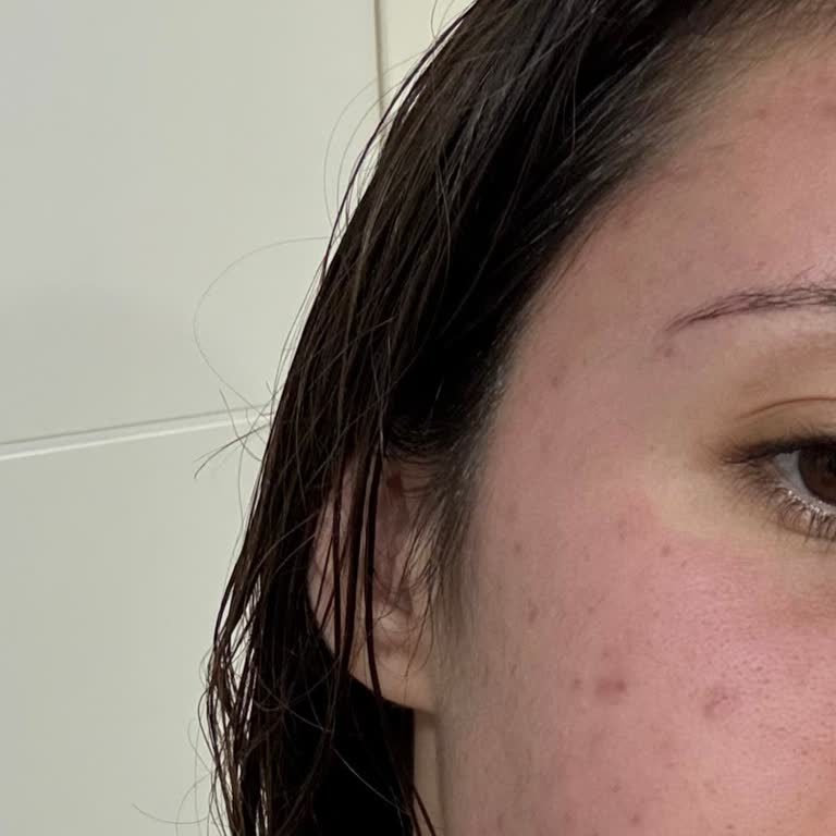 Aktif Kömür Maskesi Cildimde Şiddetli Kızarıklık Ve Yanma Yaptı