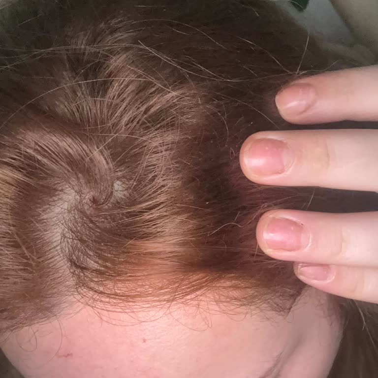 Saç Boyası Kullanımı Sonrası Ciddi Alerjik Reaksiyon Ve Acil Destek Talebi