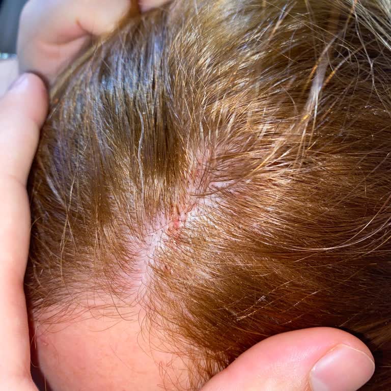 Saç Boyası Kullanımı Sonrası Ciddi Alerjik Reaksiyon Ve Acil Destek Talebi