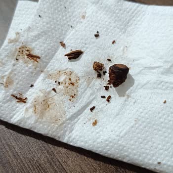 Torku Antep Fıstıklı Çikolata İçinden Yabancı Cisim Çıkması Şaşkınlığı