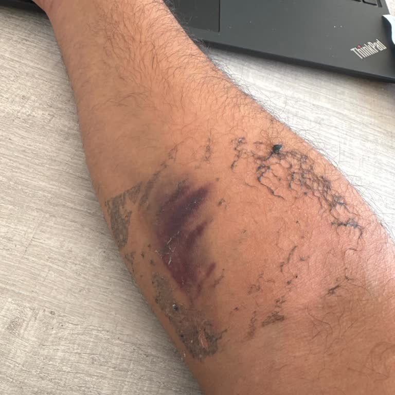 Serum Sonrası Kolumda Oluşan İz Ve Morluk İçin Çözüm Bekliyorum