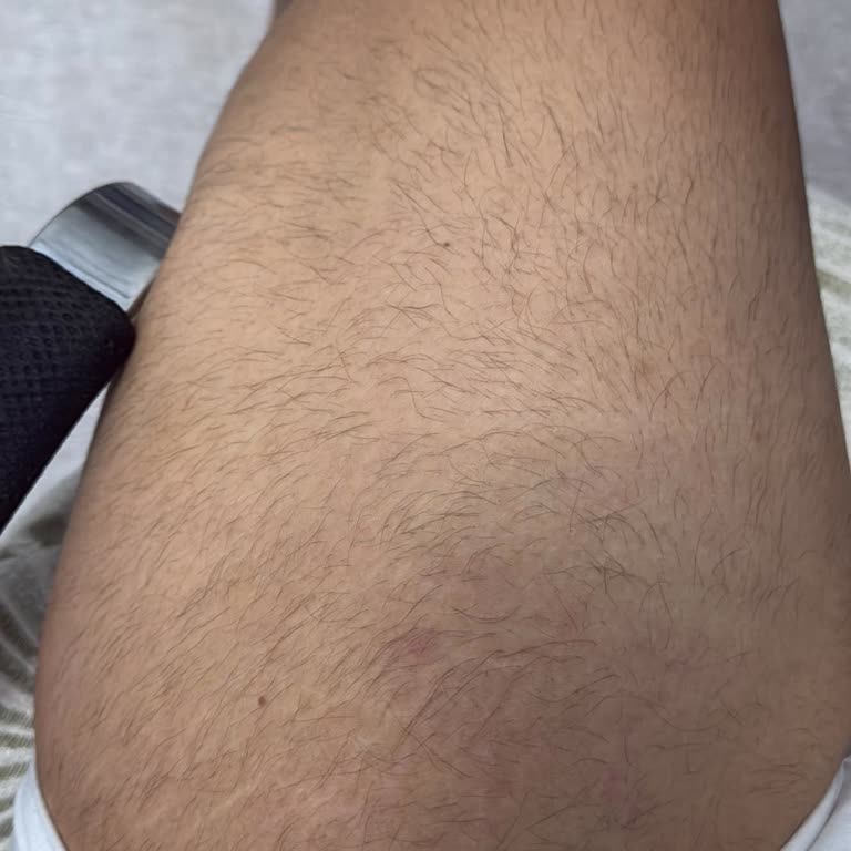 Epilasyon Sonrası Vaat Edilen Sonuçlara Ulaşamama Ve İlgisiz Şube Yönetimi