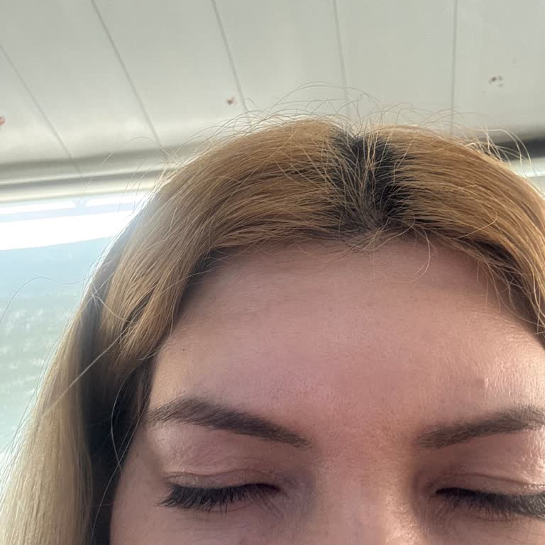 Sıvı Yüz Germe Ve Botoks Sonrası Yüzümde Asimetri Ve Kaş Düşüklüğü Oluştu, Çözüm Sunulmadı