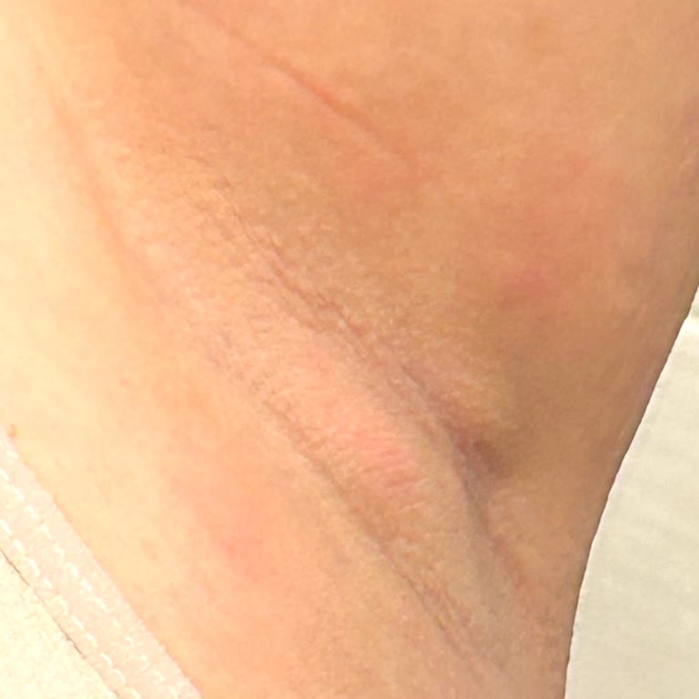 Deotak Krem Kullanımı Sonrası Koltuk Altımda Ağrılı Bezeler Oluştu