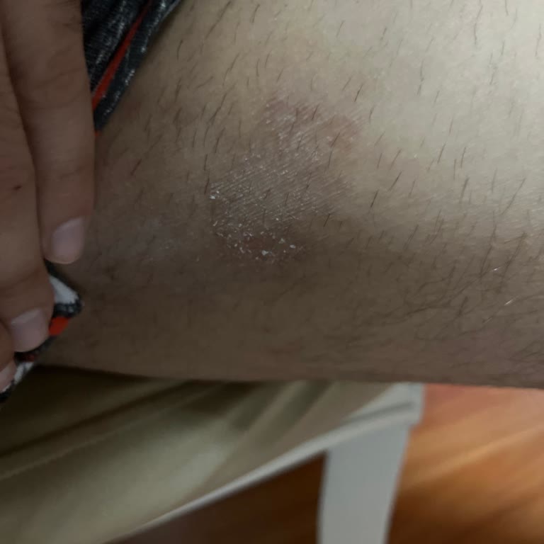 Veet Tüy Dökücü Krem Kalıcı Cilt Lekesi Ve Yanık Oluşturdu