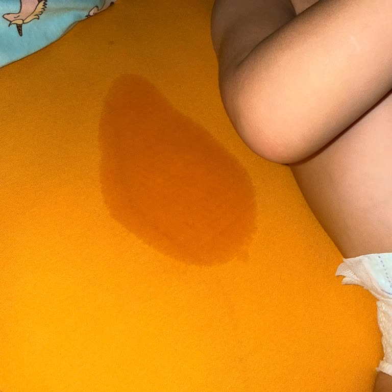 Prima Bebek Bezlerinde Sürekli Sızdırma Sorunu Ve Çözüm Bekleyişi