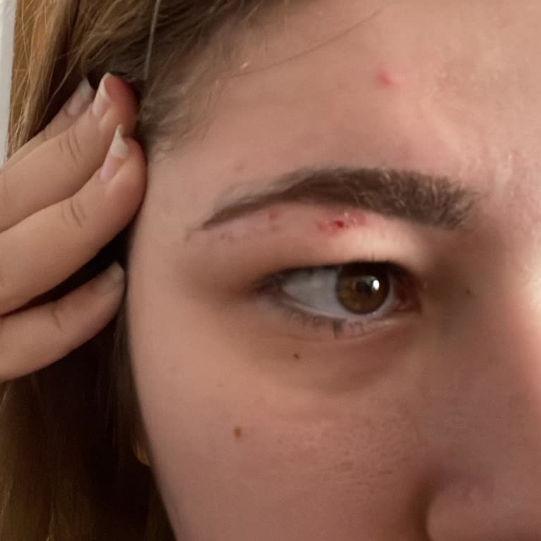 Kaş Alımı Sonrası Ciddi Tahriş Ve İlgisiz Kuaför Salonu