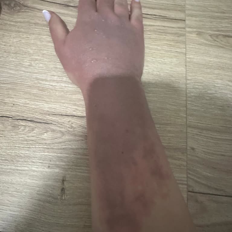 Çaydanlık Kapağı Tasarım Hatası Nedeniyle Yanık Ve Mağduriyet Yaşadım