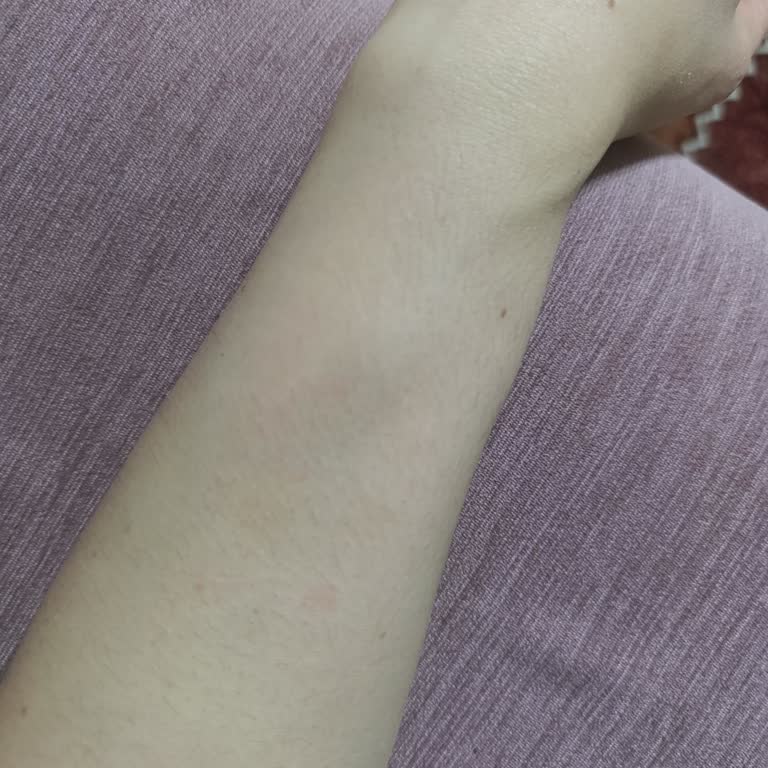 Lazer Epilasyon Sonrası Kıl Artışı Ve İletişim Engeli